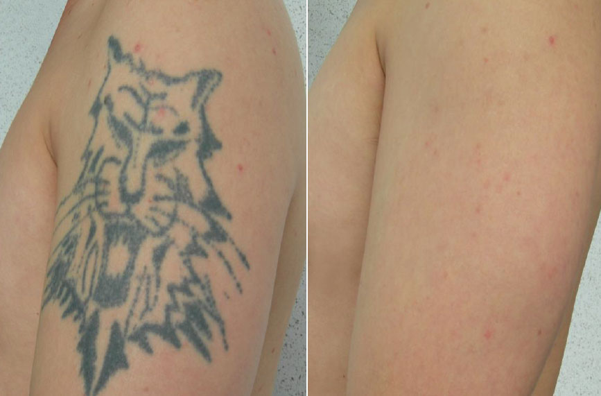 Pastelle Tattoo Removal
