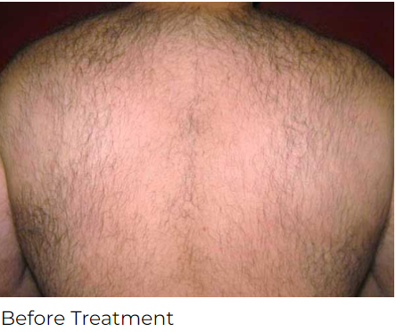 Cervello Hair Removal Before Treatment